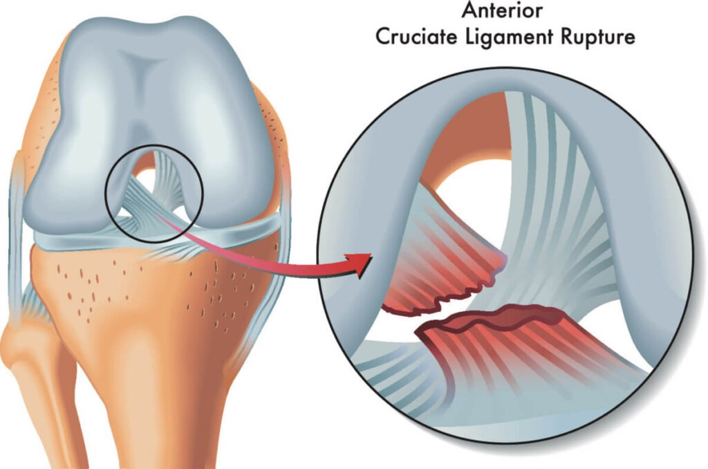 ¿Por qué las cirugías de ligamento cruzado anterior tienen un gran tasa de éxito?