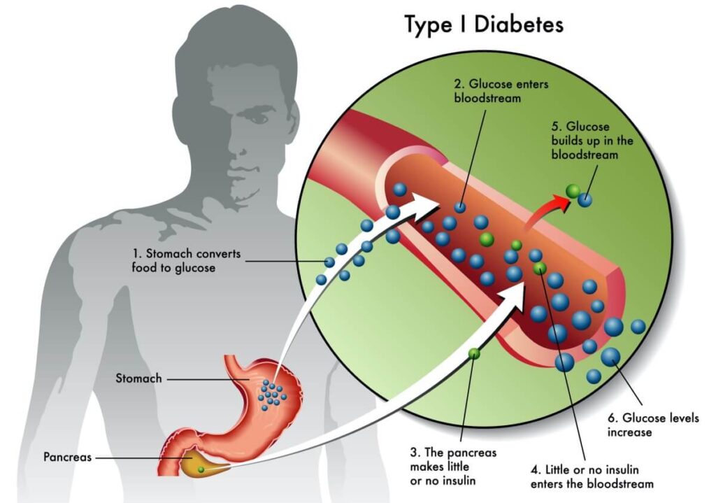 Beneficio de la actividad física para pacientes con diabetes