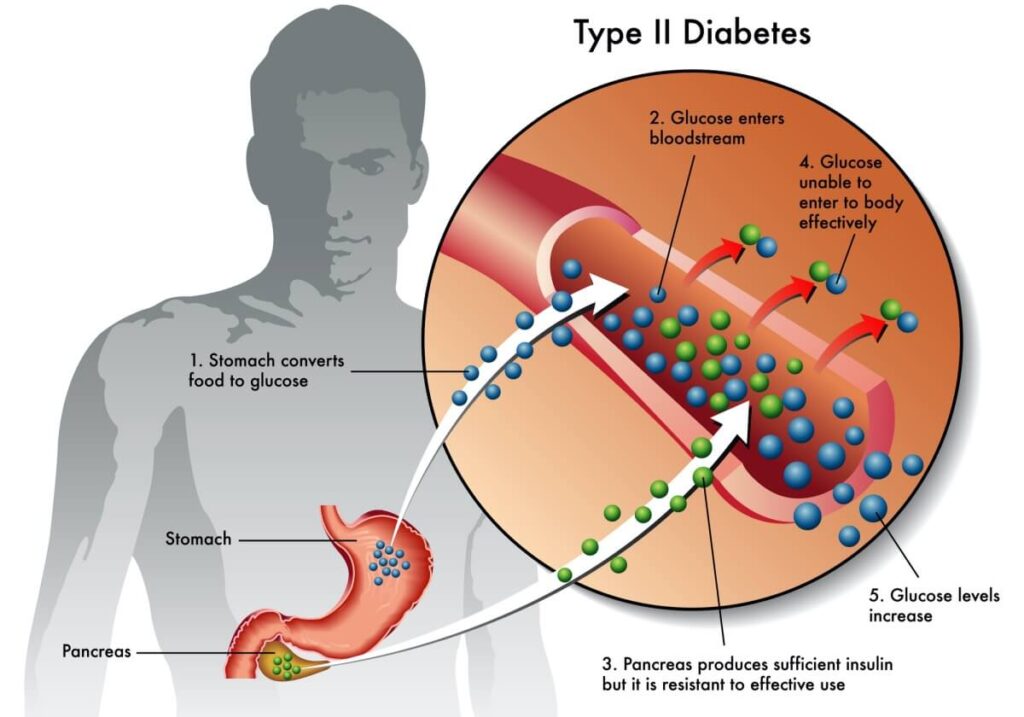 Beneficio de la actividad física para pacientes con diabetes